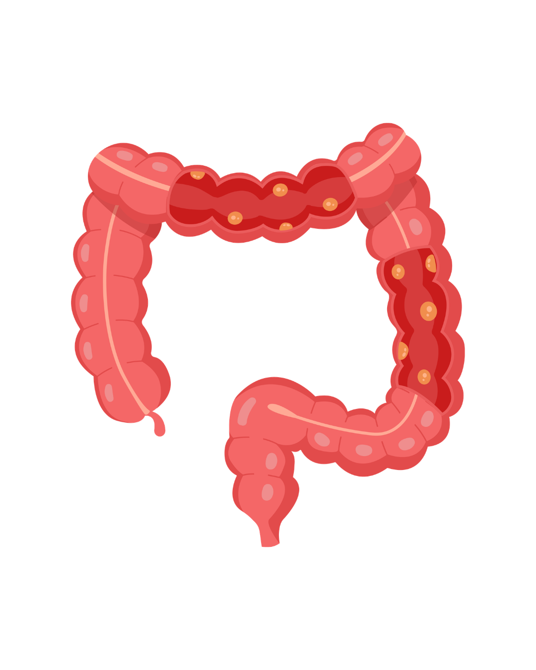 Remoção de Pólipos Intestinais