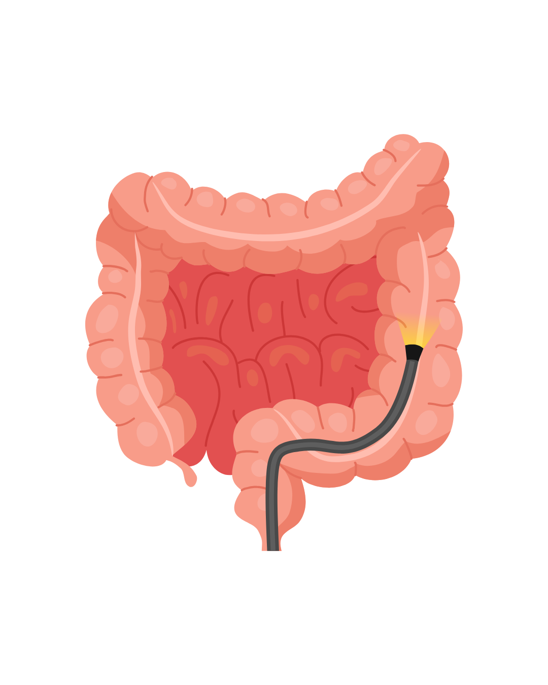 Colonoscopia